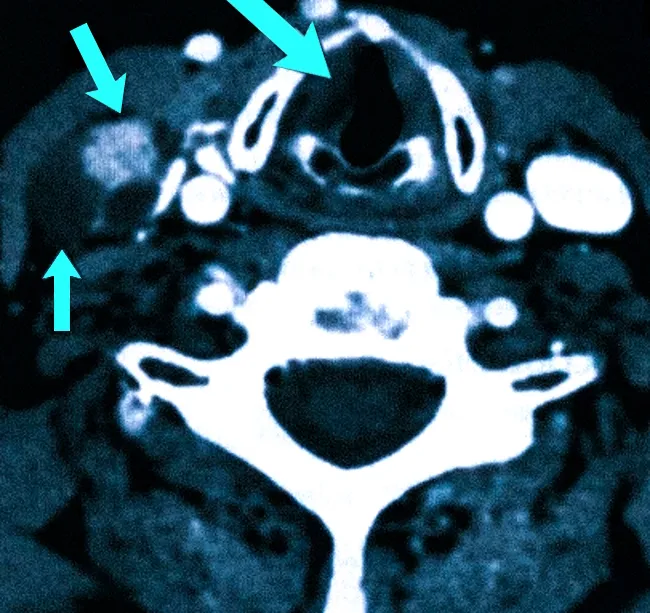  При КТ с контрастированием определяется рак щитовидной железы с метастазом в лимфоузел (отмечены стрелками)