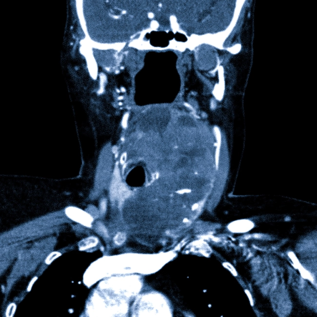 Рак щитовидной железы на КТ