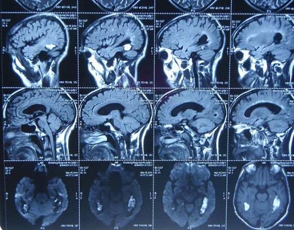 Серия послойных изображений, полученных при МР-сканировании головы