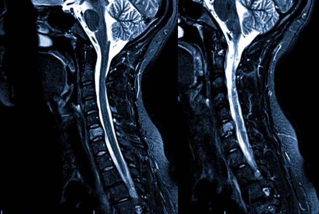 МРТ шейного отдела позвоночника