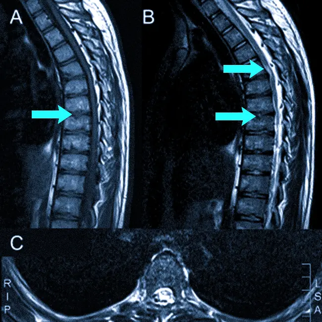 Расшифровка МРТ грудного отдела позвоночника