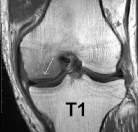 МР-скан коленного сустава в Т1 режиме