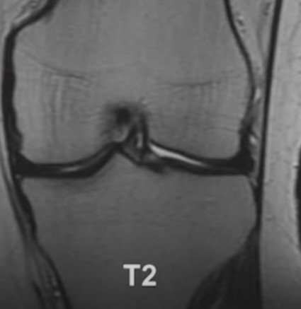 МР-снимок коленного сустава в режиме Т2