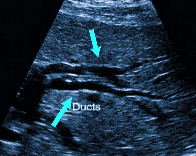Расширенные протоки внутри печени на УЗИ