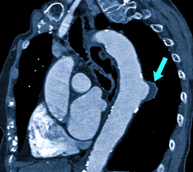 Расслоение аорты на КТ