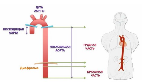 Расслоение аорты на КТ