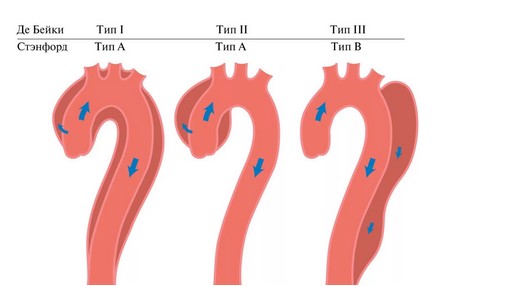 Расслоение аорты на КТ