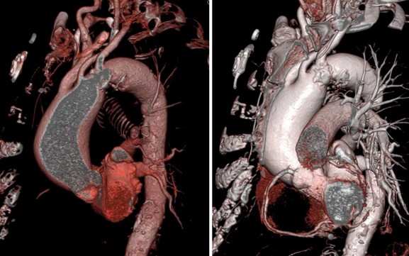  Рисунок: анатомия главной артерии организма в норме