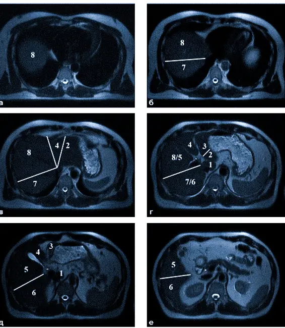 МРТ печени c сегментами