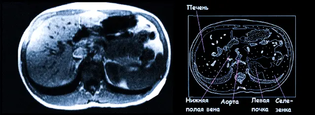 Норма печени на МРТ