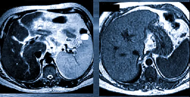 МРТ печени цирроз