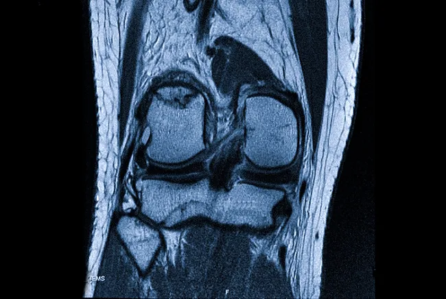 Повреждение медиального хряща на снимке МРТ