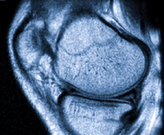 Разрыв заднего рога медиального мениска на снимке МРТ