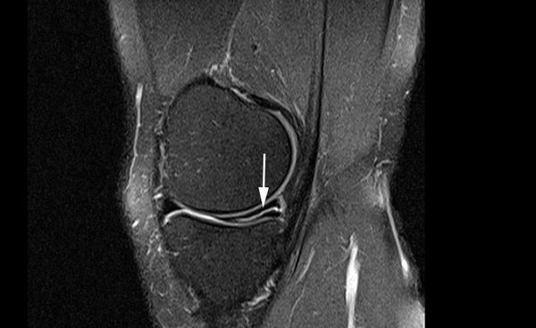 Томограмма коленного сустава при радиальном разрыве мениск