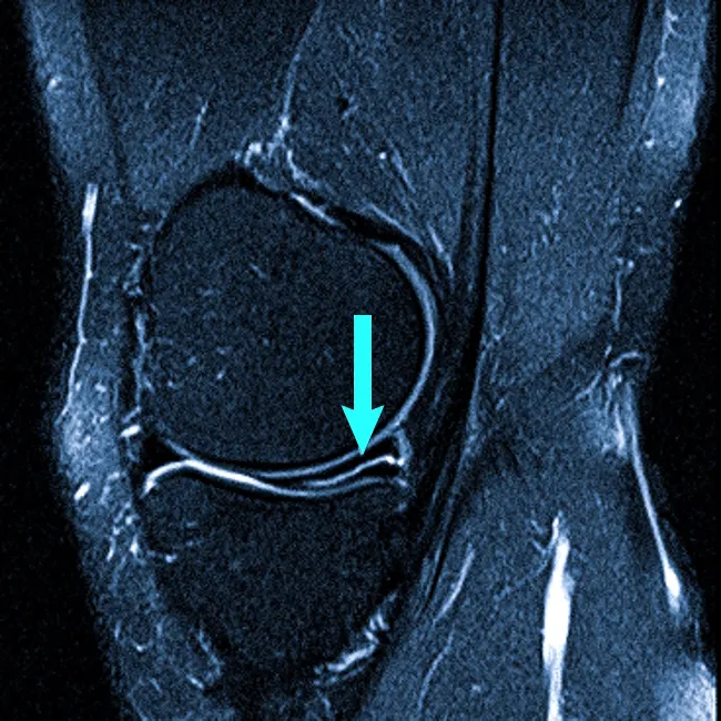 Разрыв мениска коленного сустава на МРТ
