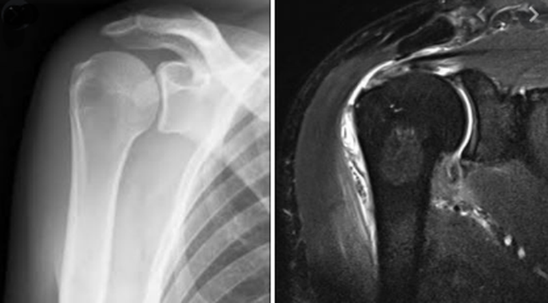 Плечевой сустав на рентгене и на МРТ