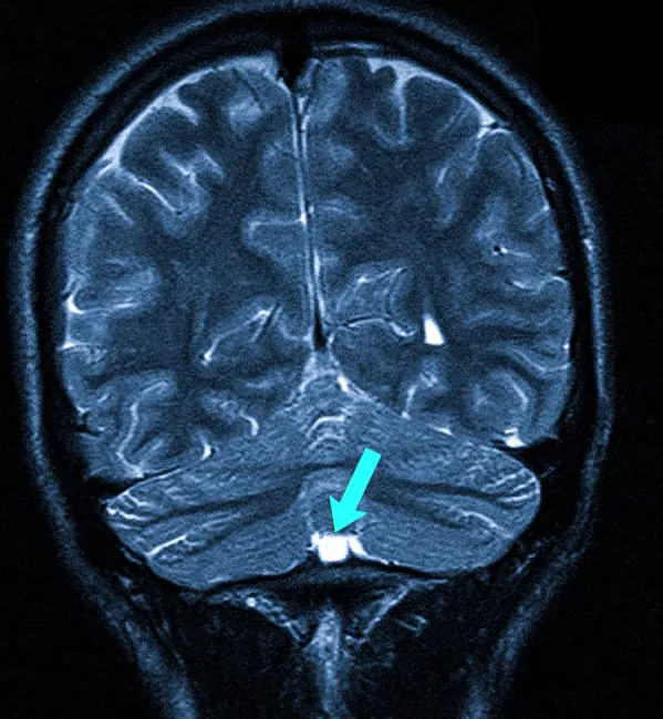 Мелкая ретроцеребеллярная киста на МР-снимке