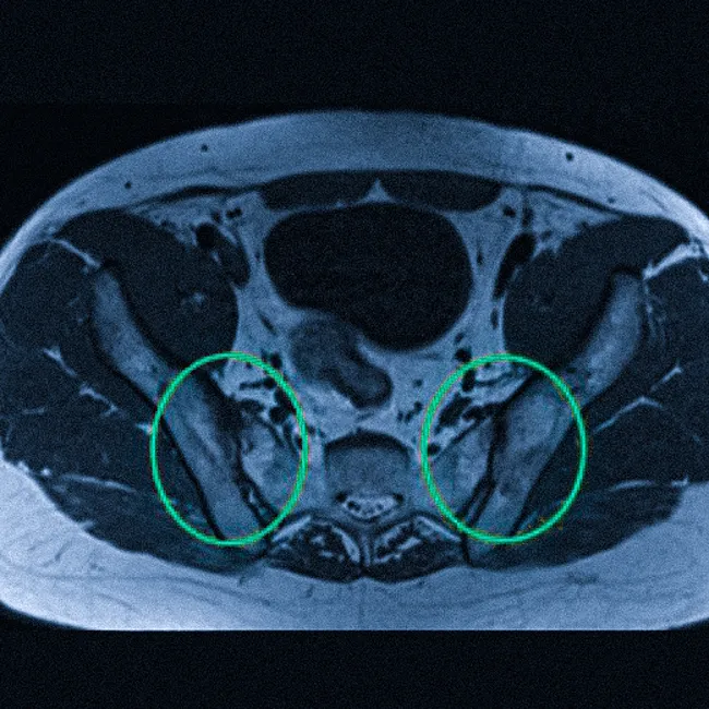 Сакроилеит на МРТ