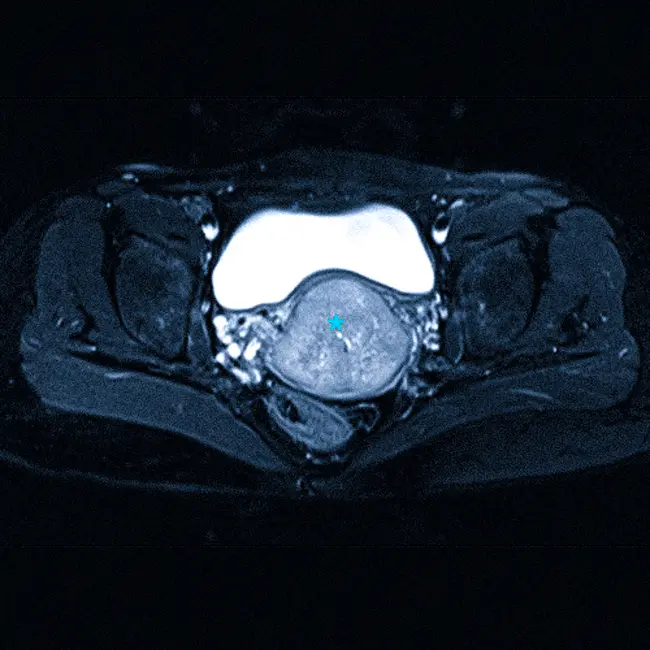 Саркома матки на МРТ