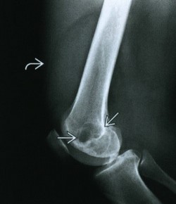 Рентгенография у пациента с пигментным ворсинчато-узелковым синовитом