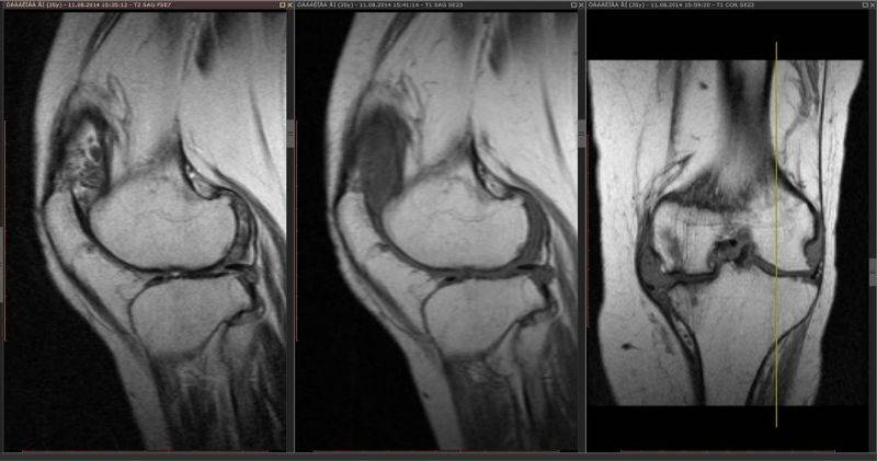 Синовит коленного сустава на снимках МРТ, сагиттальная и фронтальная проекции