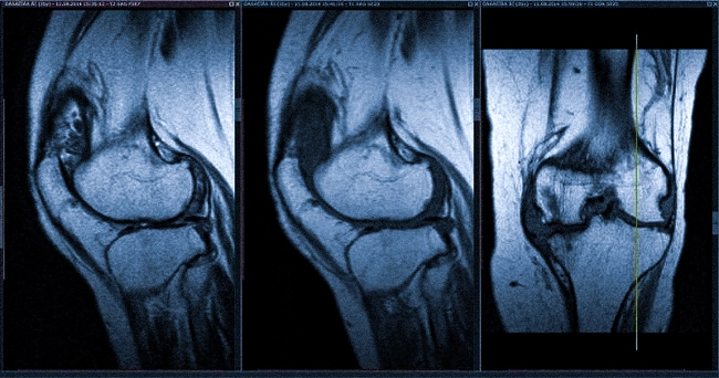 Синовит коленного сустава на снимках МРТ, сагиттальная и фронтальная проекции
