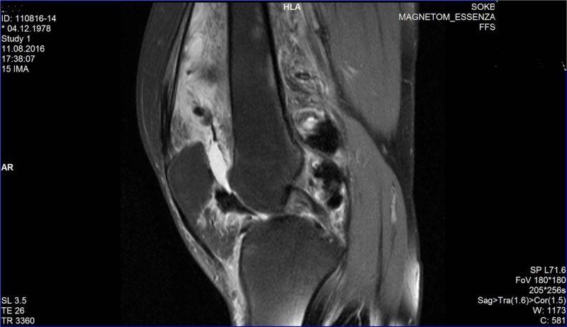 Пигментный виллезонодулярный синовит коленного сустава на снимке МРТ