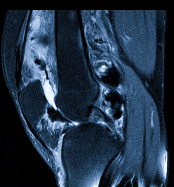 Пигментный виллезонодулярный синовит коленного сустава на снимке МРТ