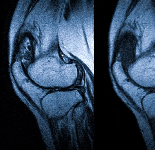 Синовит коленного сустава на МРТ