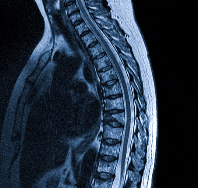 МР-скан грудного отдела позвоночного столба 