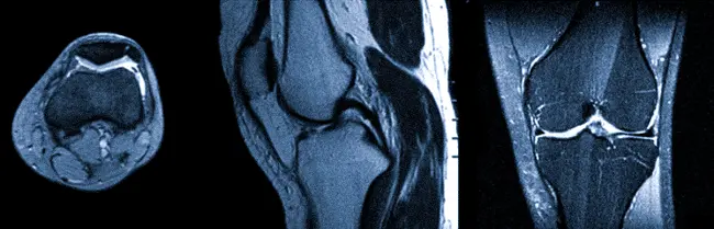 Сколько длится МРТ коленного сустава