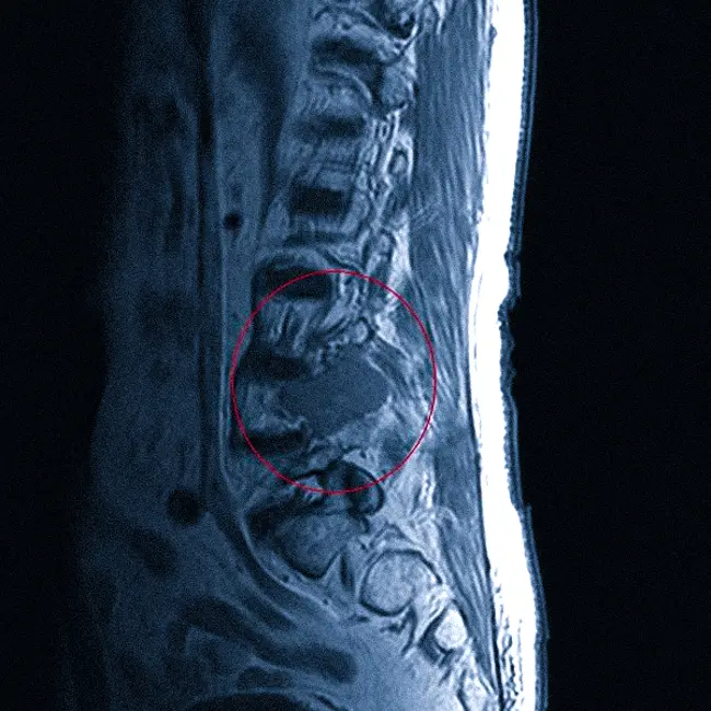 Опухоль пояснично-крестцового отдела позвоночника на МРТ