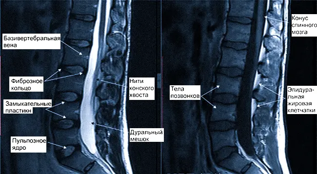 МРТ снимок поясничного отдела