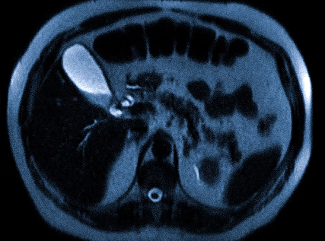 Сладж в желчном пузыре на МРТ