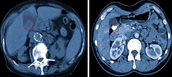 Сладж желчного пузыря на КТ