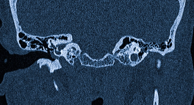 Объемное образование среднего уха на КТ