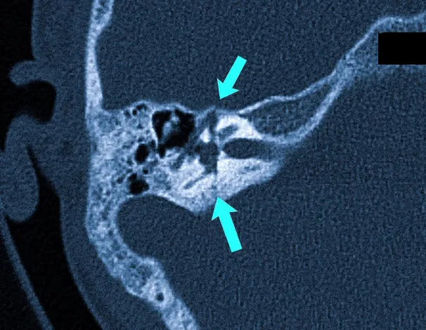 Поперечный перелом (стрелки) височной кости на КТ