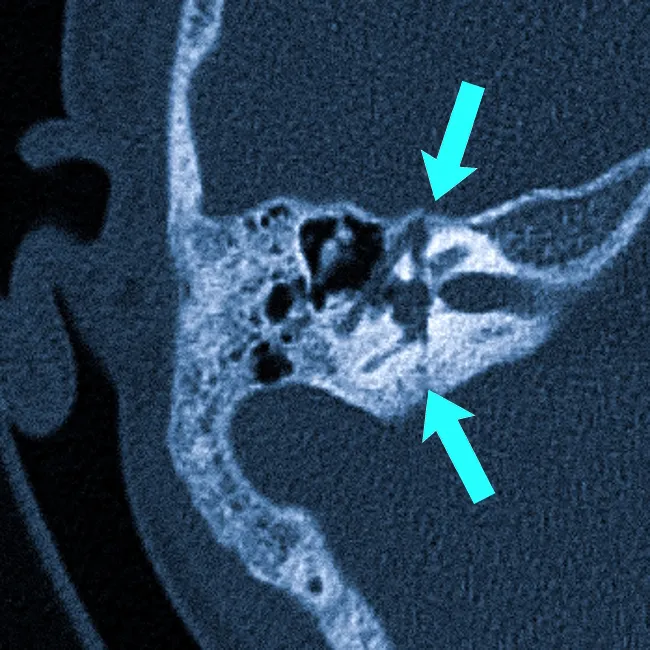 Слуховые косточки на КТ