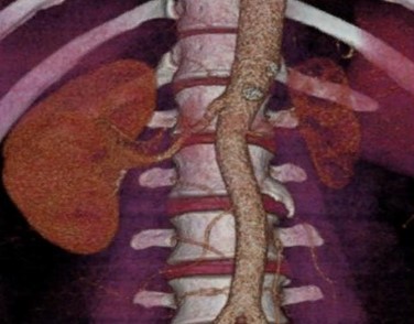 Терминальная стадия нефросклероза справа