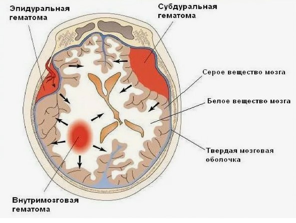 stadii gematomy na kt 1