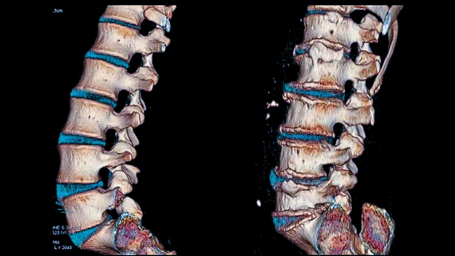 Снижение высоты межпозвонковых дисков на КТ (слева - начальные проявления, справа - выраженный дегенеративный процесс)