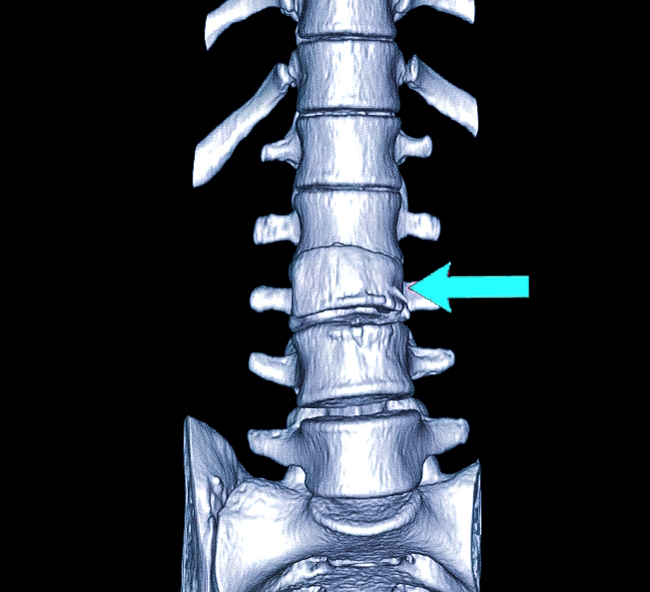 Компрессионный перелом позвоночника на КТ
