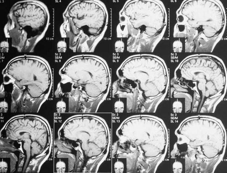 Результаты МРТ головного мозга