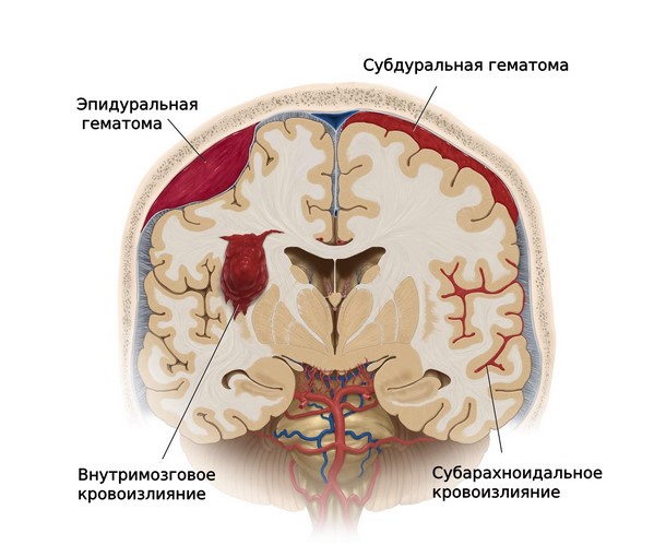 Варианты кровоизлияний в головной мозг