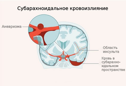 Схематическое изображение разрыва мешотчатой аневризмы с кровоизлиянием в подпаутинное пространство