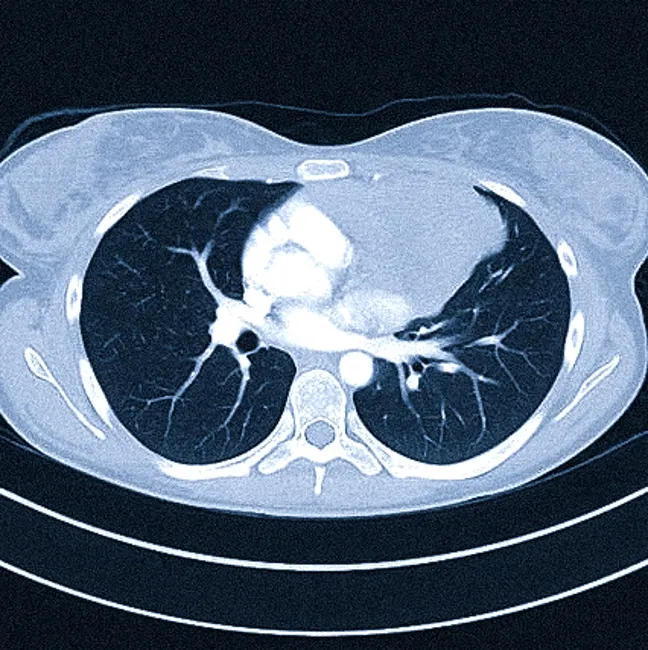 Применение КТ органов грудной клетки
