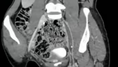 Тромбоз нижней полой вены на КТ
