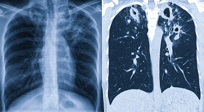 Рентгенограмма (слева) и компьютерная томограмма (справа): туберкулезное поражение верхних долей с обеих сторон