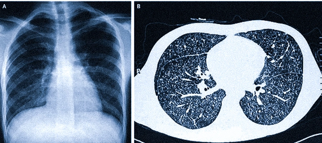  Визуализация милиарной диссеминации на рентгене и КТ-снимке