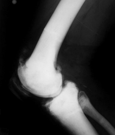 Рентгенодиагностика мраморной болезни